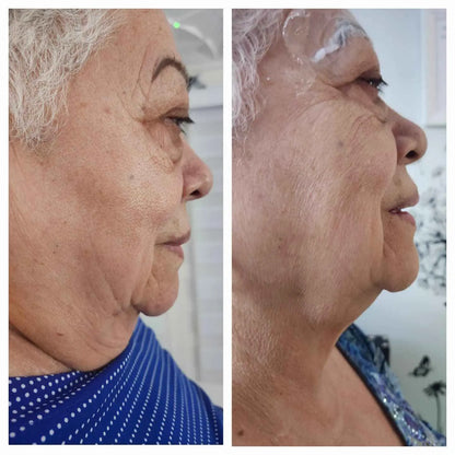 Enzy Dermik Results 1 double chin